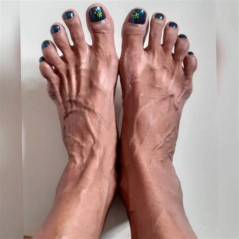 Hi My mother is suffering with varicose veins from 3 years in the left leg feet. . Veiny feet